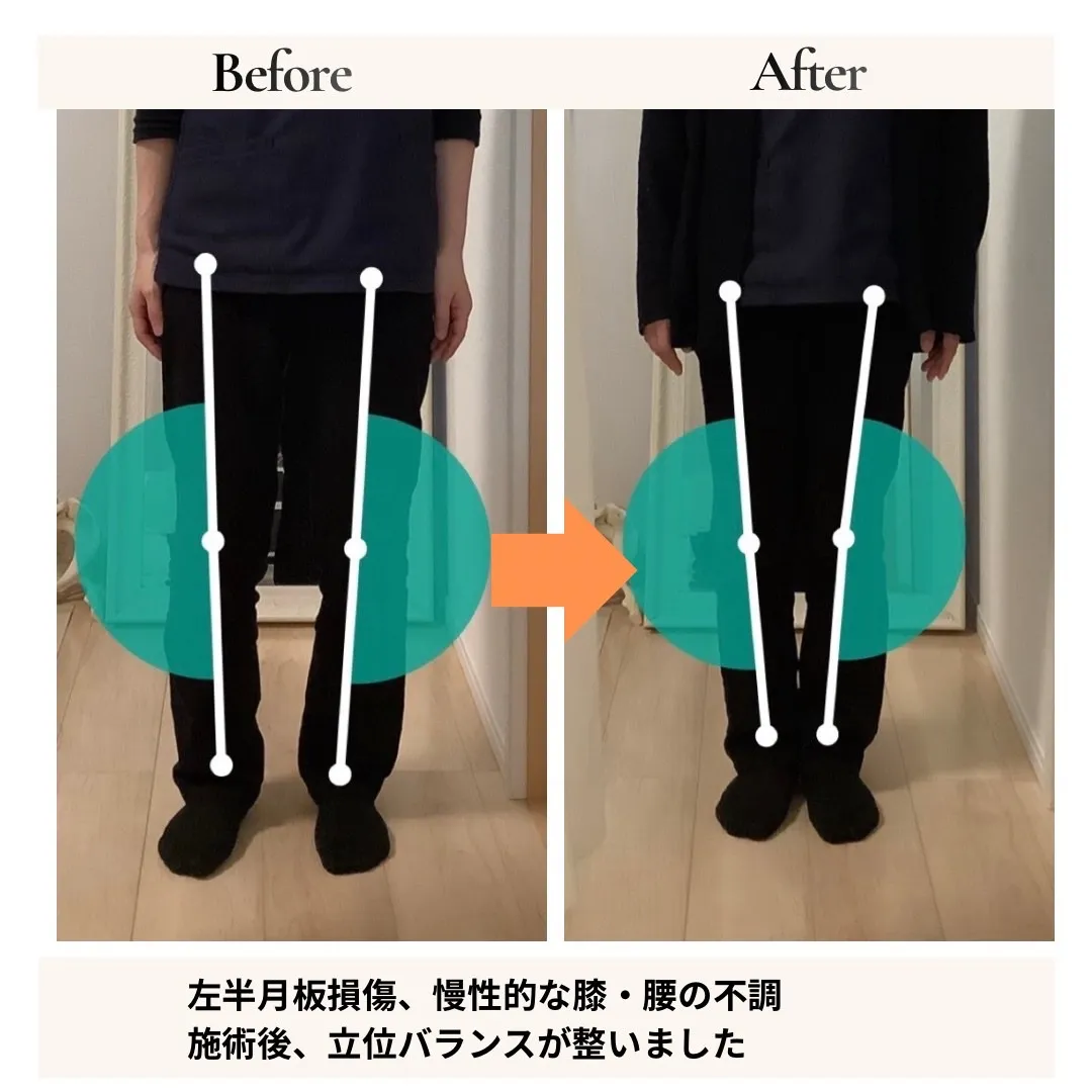 左股関節の痛み改善事例