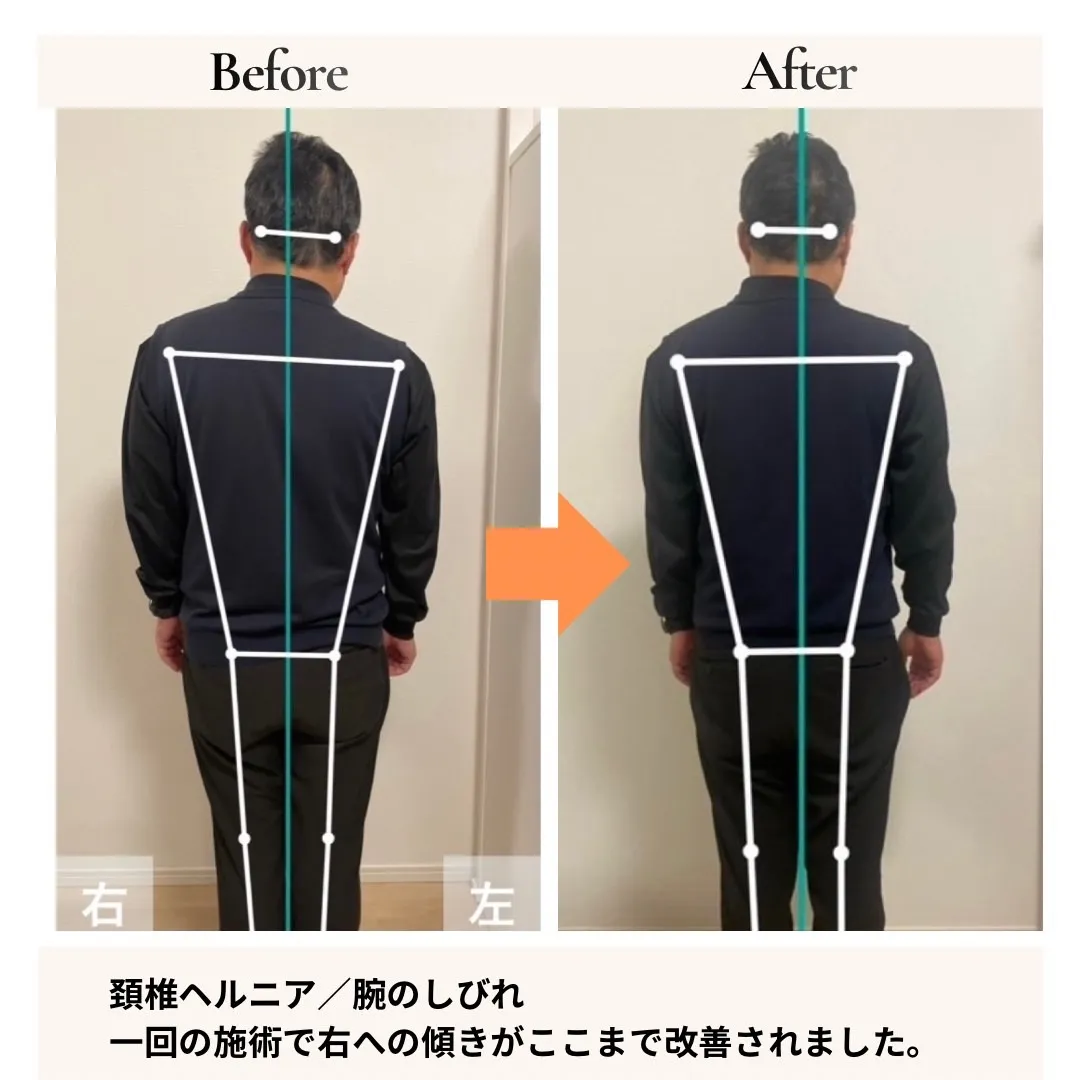 頸椎ヘルニア・腕のしびれ 背面