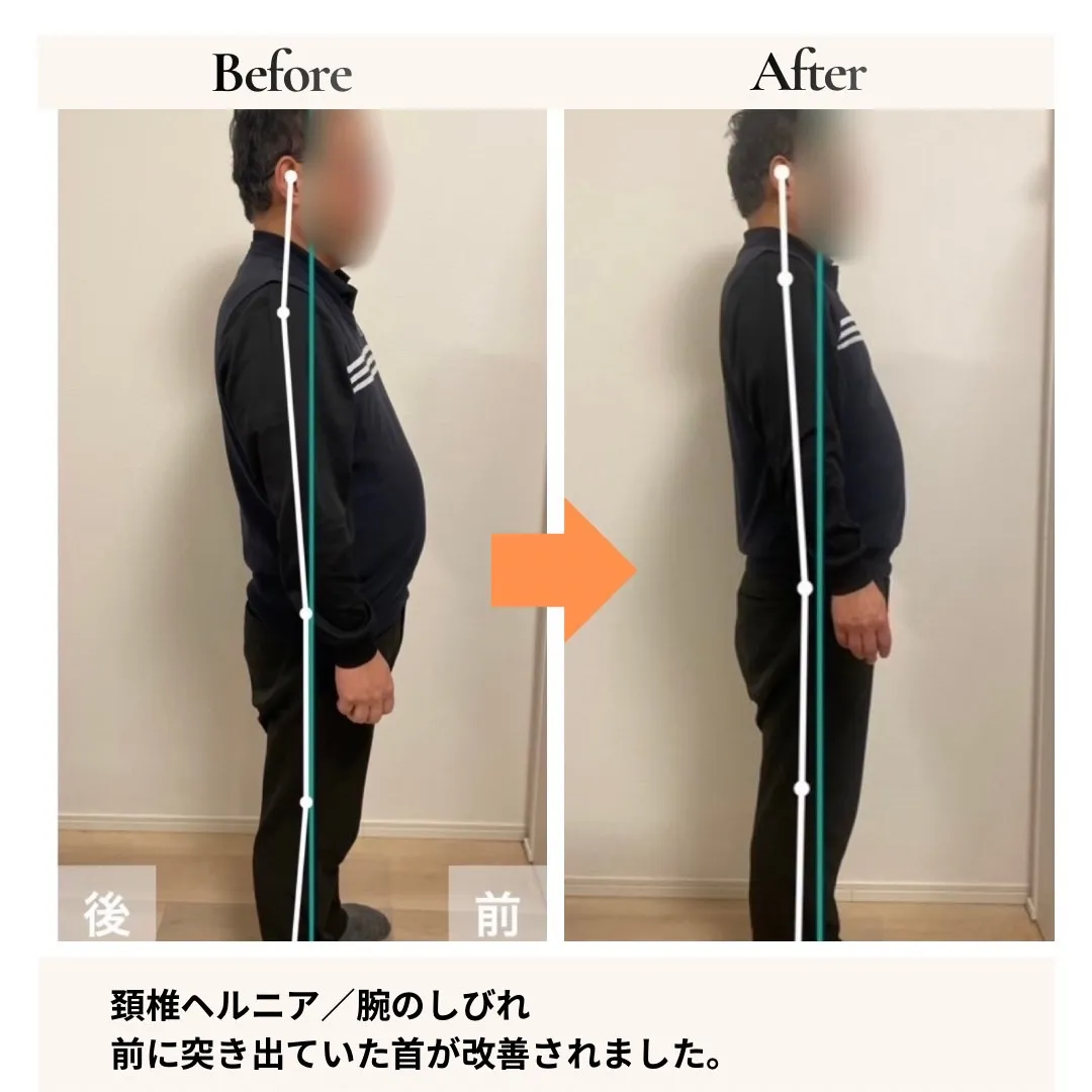 頸椎ヘルニア・腕のしびれ 側面