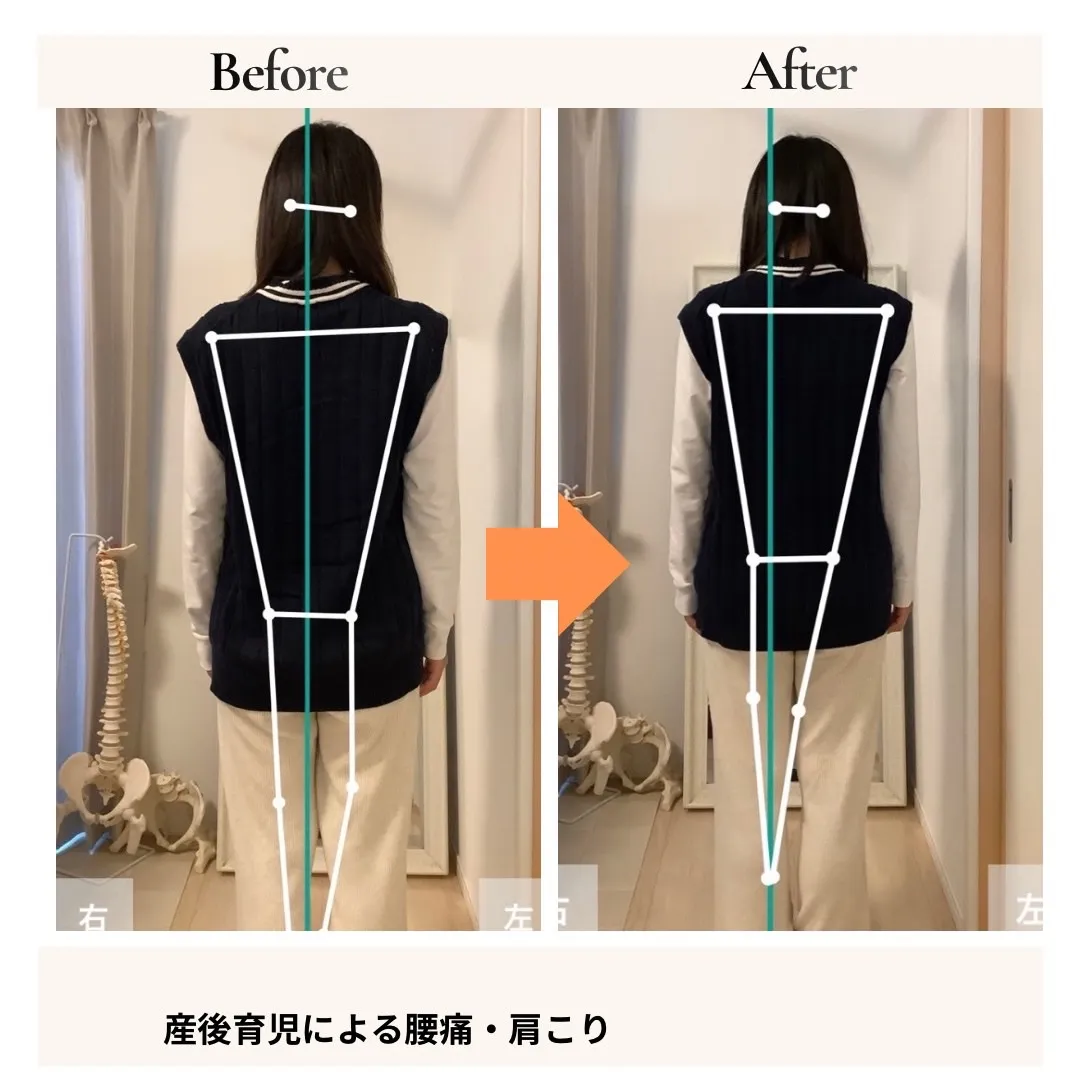 産後腰痛の改善事例
