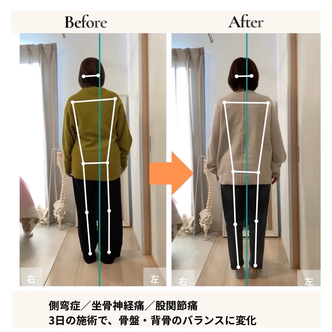 側弯症改善の事例